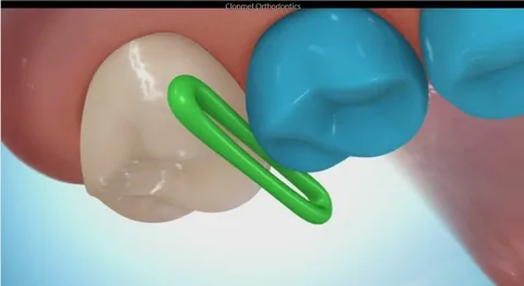 The Essential First Step in Orthodontic Corrections: The Role of Separators